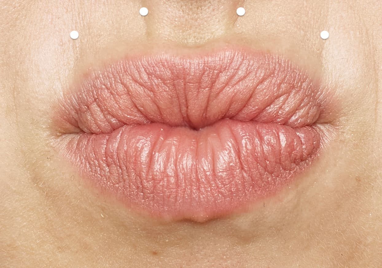 Botox Behandlung bei Lippenfalten