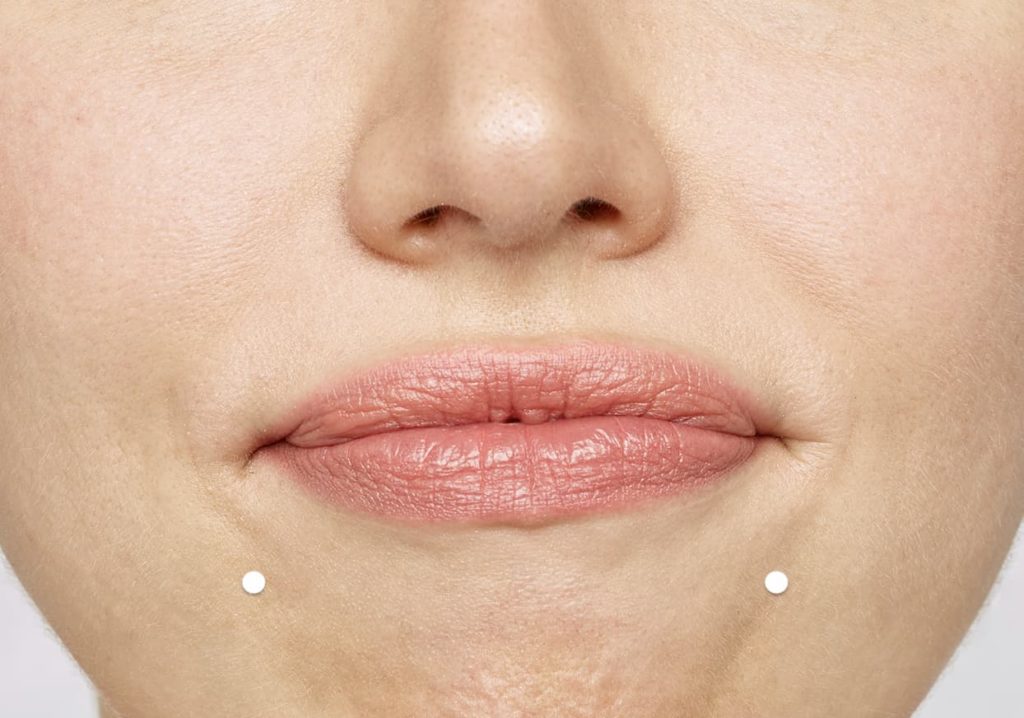Botox  treatment of marionette lines